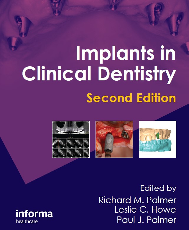 Implants in Clinical Dentistry